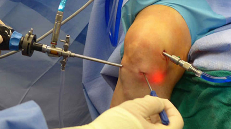 Joint Replacement