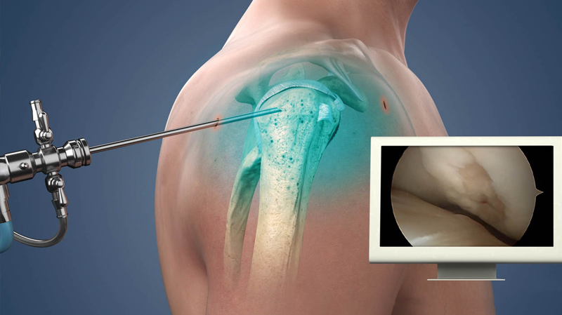 Joint Replacement
