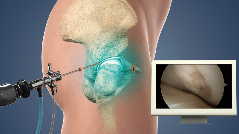 Joint Replacement