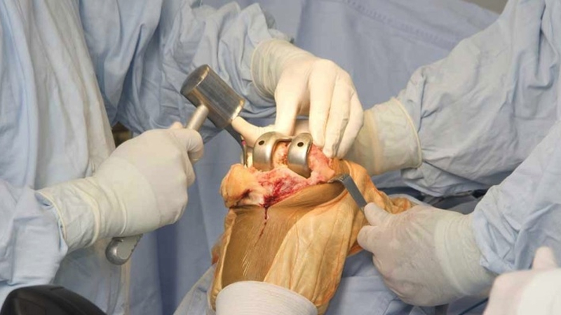 Joint Replacement