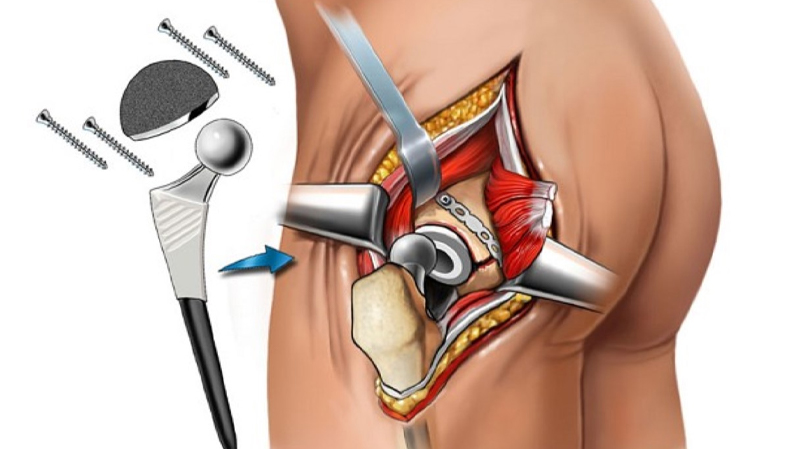 Joint Replacement