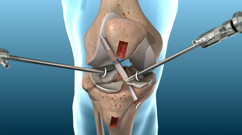 Joint Replacement
