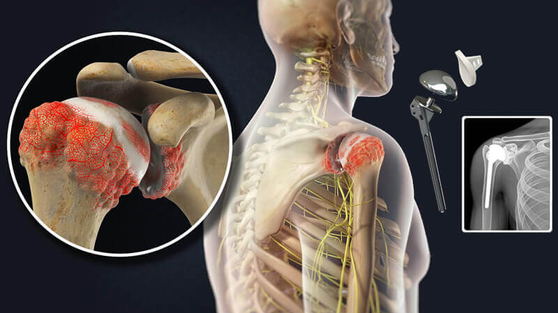 Joint Replacement